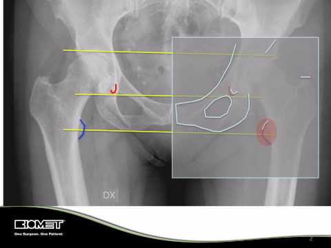 Osteocondrosi e Arnica comp.-Heel iniezioni nella regione lombare I muscoli della schiena fanno male da un carico di fare