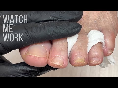 Watch me work and explain dry pedicure.