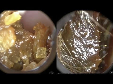 129 - WAXscope®️ used to Remove Dead Skin & Ear Wax in Patients with Otitis Externa & Glue Ear