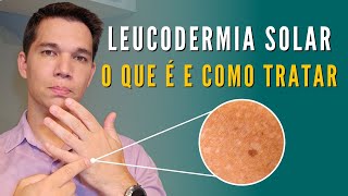 Manchas brancas na pele? Leucodermia Solar: Saiba como tratar!