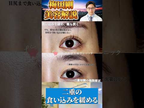 医学科 二重幅を狭く、食い込みを緩める修正　 #うめだ美容外科クリニック #美容 #他院修正
