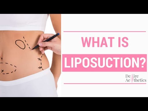 Liposuction Treatment in Chennai