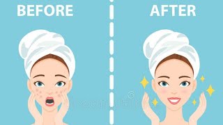 How To Get Rid Of Acne OVERNIGHT