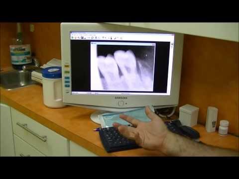 Explaining the digital dental x-ray system