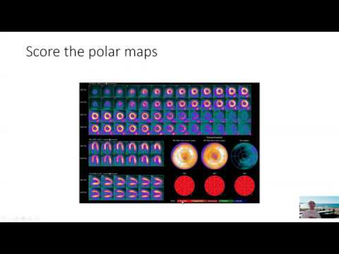 Reading a Normal Cardiac PET Scan