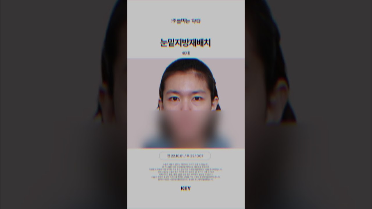 40대 의사가 직접 받는 눈밑지방재배치 대구키성형외과