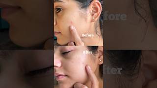 How do I treat my pus filled acne in 24 hour? Come watch ♥️ #acne #clinicalcosmetologist