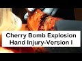 Cherry Bomb Explosion Hand Injury-Version I
