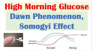 High Early Morning Glucose | Dawn Phenomenon &amp; Somogyi Effect