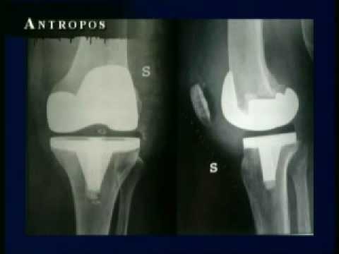 Lanatomia dellarticolazione della spalla Trattamento di acne sul collo in uomini cause