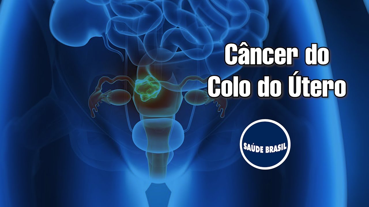 Câncer do Colo do Útero