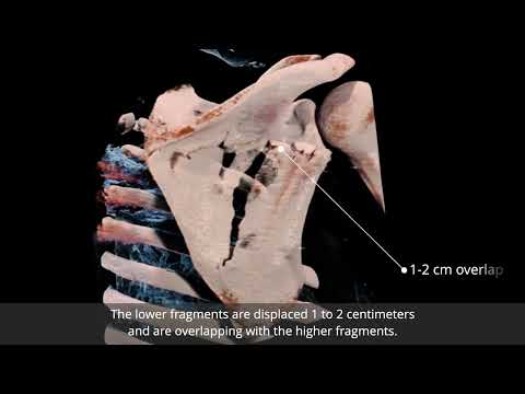 Anatomage Table Patient Case 2560: Scapula Fracture