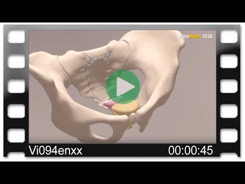 DynaMesh®-CESA - Animation: Cervicosacropexy - Bilateral Fixation - Level Promontory