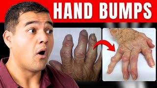 Why You Get Lumps on Your Hand (and What They Really Mean)