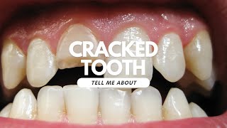 Cracked Tooth