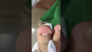 Ep_8747 Ingrown toenail removal 👣 ออกมาแล้วรึครับ 😅 (clip from Thailand)