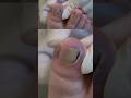 Bleeding Of An Ingrown Nail Can Be Made Worse By Doing This