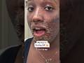My face is LITERALLY peeling off 😱🧴#skincaretips, #chemicalpeeljourney, #skinglow, #aftercare