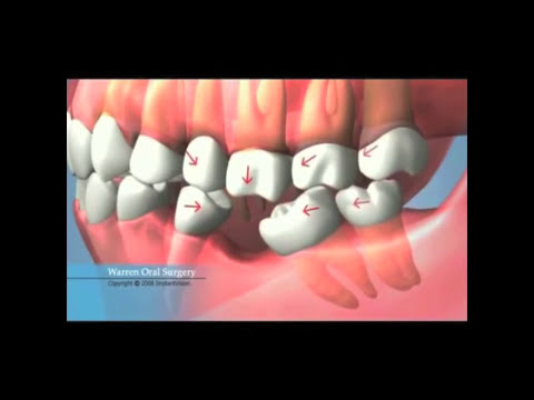 Lipsa unui dinte - consecinte