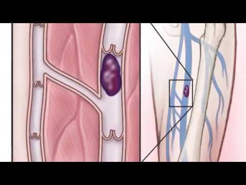 Deep Vein Thrombosis