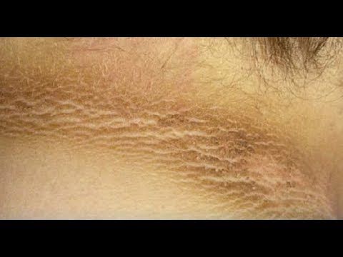 Siccome il posto di pigmentary è chiamato Lolio di ricino da pigmentary nota su una faccia di una fotografia