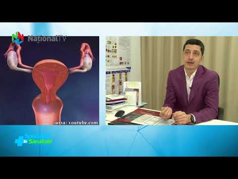 DESPRE CANCERUL OVARIAN, cu Dr. Nicolae Boleac
