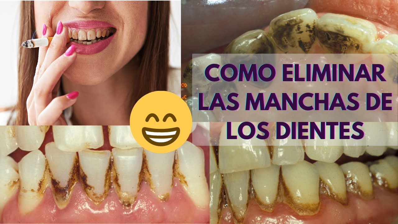 COMO APARECEN LAS MANCHAS DENTALES 🦷 [SOLUCIONES PARA ELIMINARLAS EN 2022 ✅🙌]