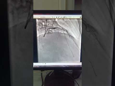 LAD CTO.. successful PCI