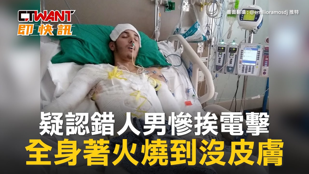 圖說-疑認錯人男慘挨電擊　全身著火燒到沒皮膚