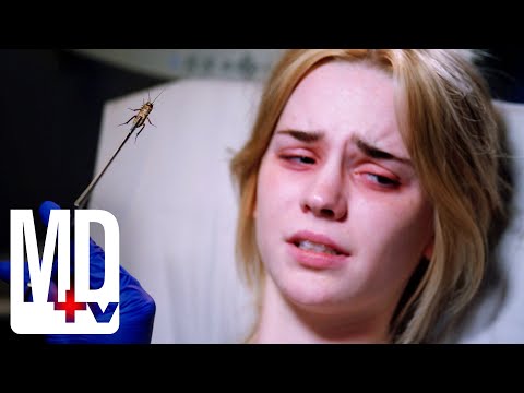 Cockroach Living INSIDE Her Head | Chicago Med | MD TV