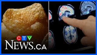 Enjoy eating chips and fast food? New study sheds light on how this could increase dementia risks