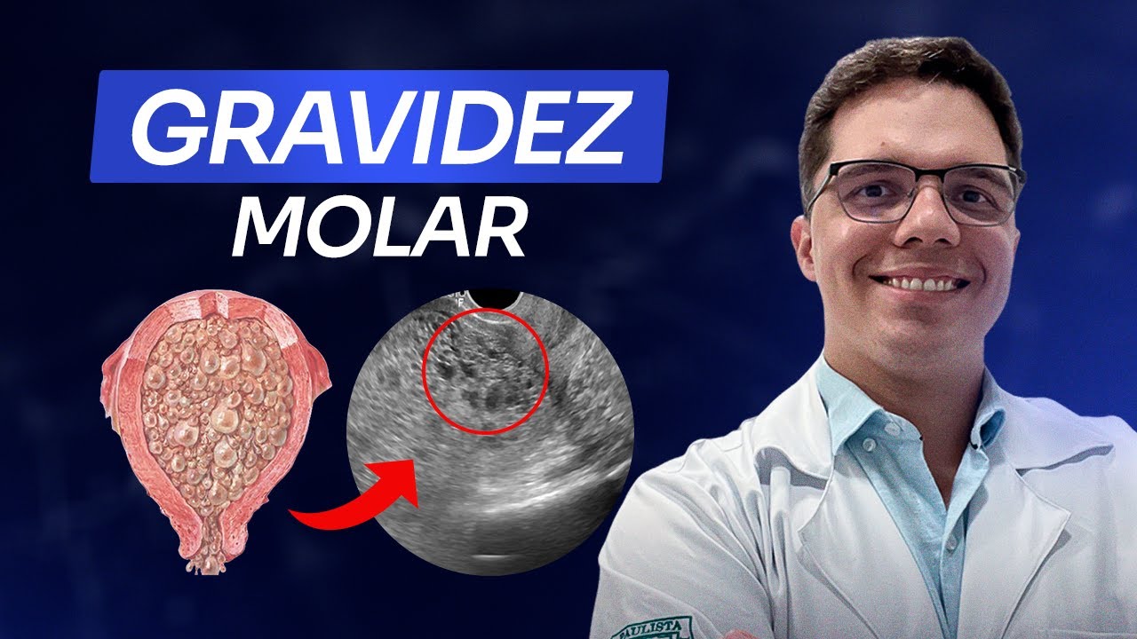 O que é Mola Hidatiforme (e como identificar no ultrassom)
