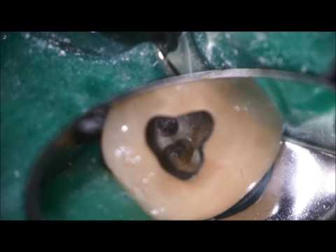 Finding Calcified Canals: Microscopic Endodontics