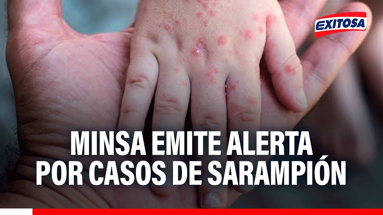🔴🔵 Ministerio de Salud emite alerta epidemiológica por incremento de casos de sarampión
