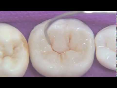 Tips for Esthetic Dentistry - Posterior Sculpture