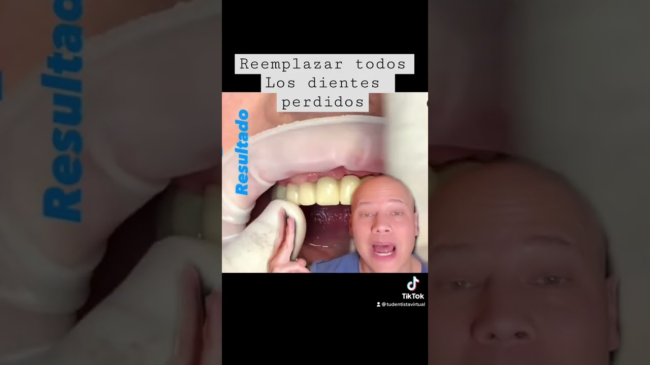 Cuantos implantes para reponer todos los dientes perdidos