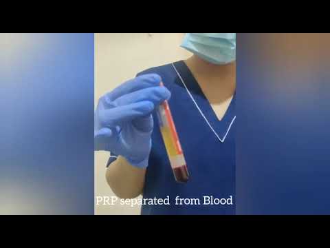  PRP hair treatment Aspen Clinic | Dr. Hina Khan