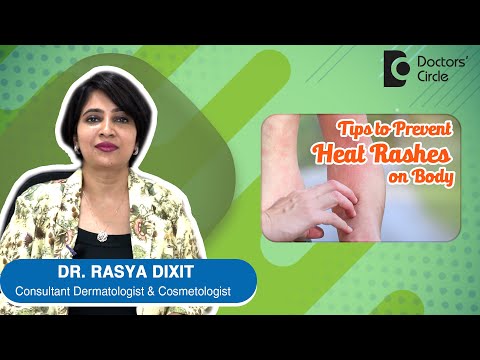 Cure for Heat Rashes / Sweat Rashes - By Dr. Rasya Dixit | Doctors' Circle