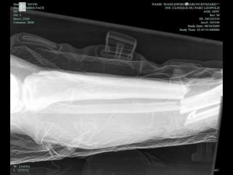 Brutal foul on Wasilewski - X-ray pictures