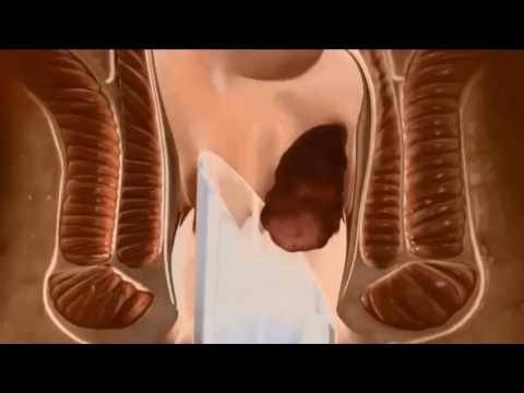 Rubber Band Ligation of Internal Haemorrhoids - English