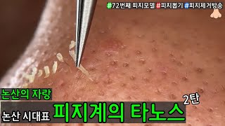 피지 직접 뽑아드렸습니다 _ 피지제거 블랙헤드제거 피지뽑기 _ 논산에 살아있는 피지의 전설 새해를 아주 밝게 빛내주네요 2탄