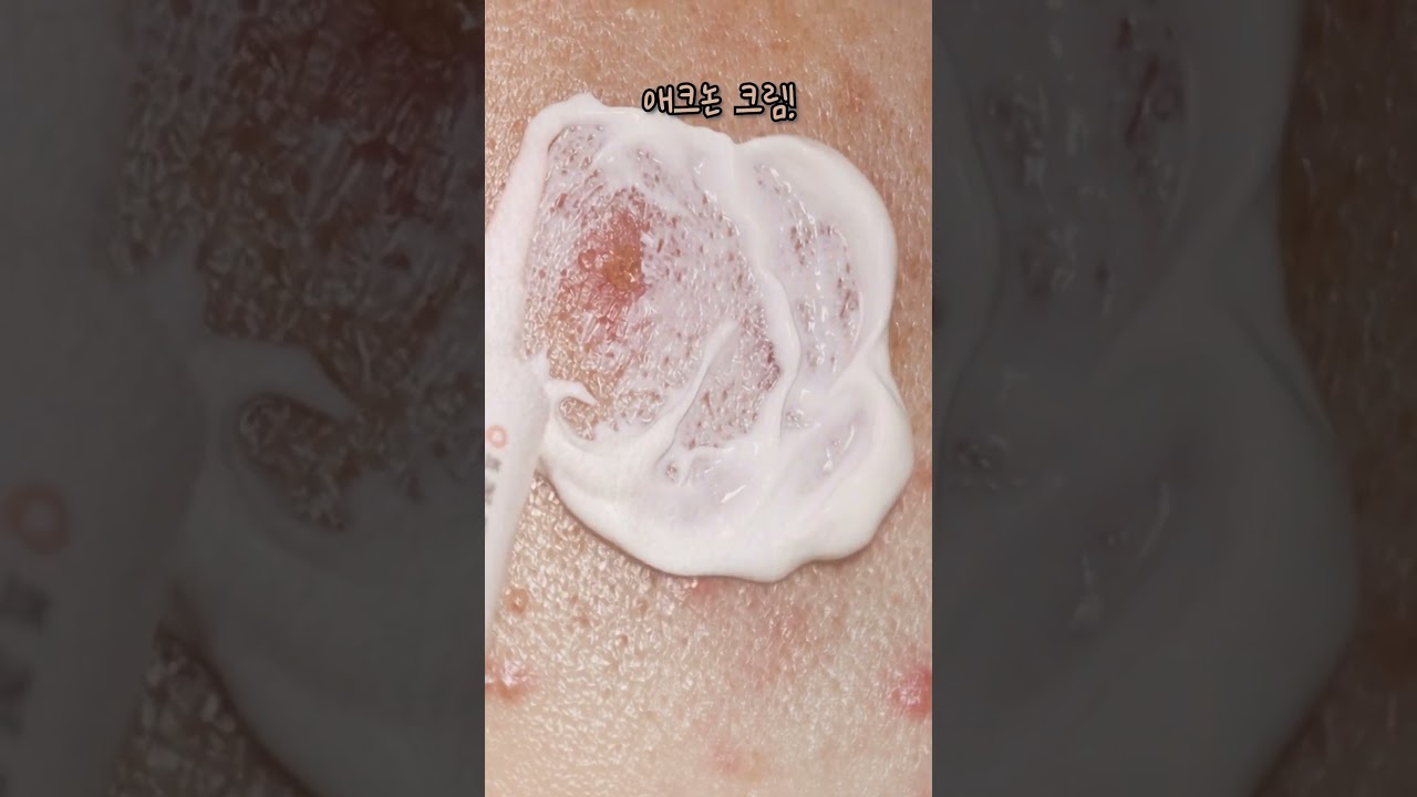 [애크린&애크논] 여드름 증상에 맞춰 애크듀오!