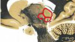 Neuroanatomy: Sagittal Slice @ Uncus and Mid Thalamus