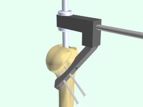 Oligoelementi per le articolazioni Sciatica e trattamento osteocondrosi rimedi popolari