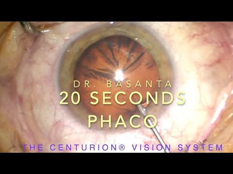 Twenty Seconds Phaco