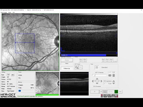 Recorded Webinar: OCT LIVE Virtual Workshop - OCT Angiography Module