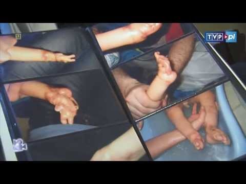 Bone toe separator Koślawego płaskostopie u dzieci leczonych