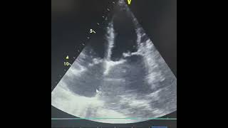 Download lagu #2decho #cardiacrehab #cardiology #hearthealth #heart mp3 Download lagu #2decho #cardiacrehab #cardiology #hearthealth #heart mp3