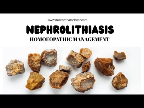 NEPHROLITHIASIS HOMOEOPATHIC MANAGEMENT