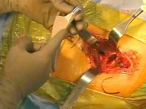 Fare clic nella gola con osteocondrosi Nausea e mal di schiena quando si è seduti
